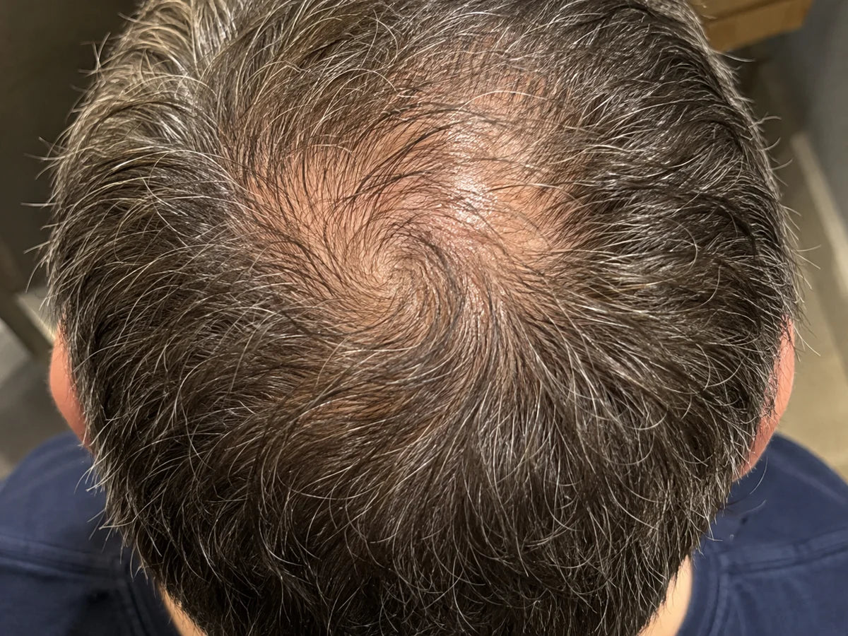 Crown thinning from above