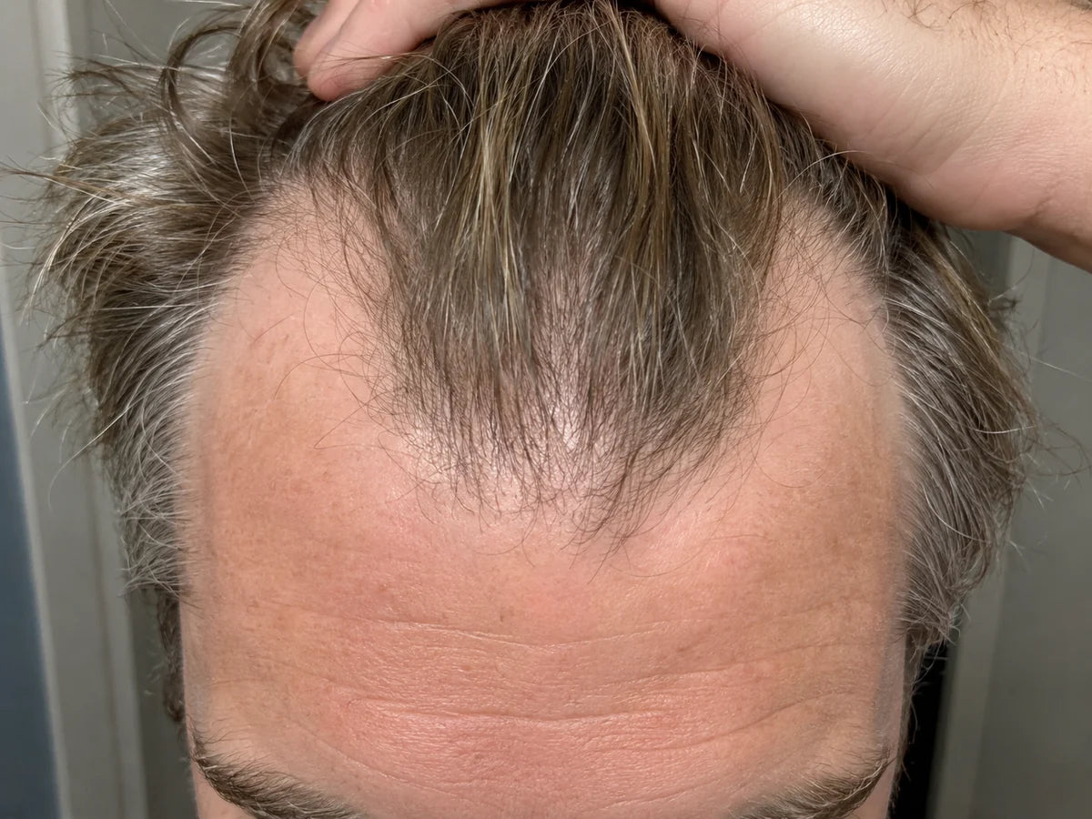 Man checking his receding temples